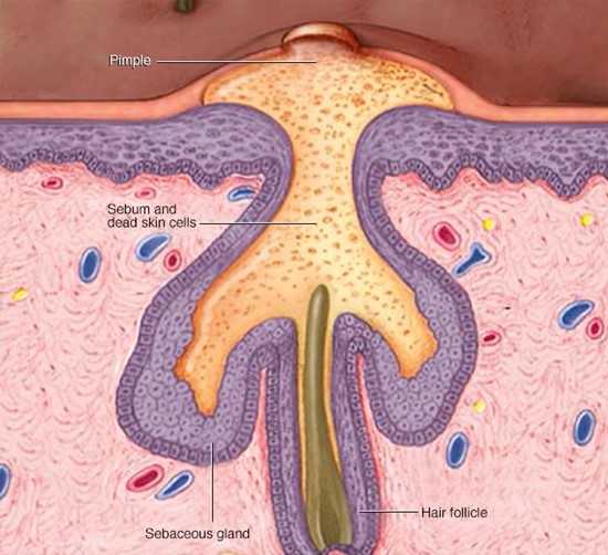 How acne develops