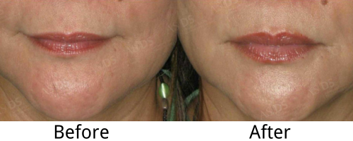 Hyaluronic Acid on Lips: Before and After