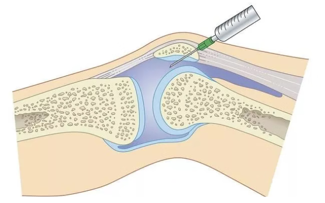 Hyaluronic Acid Injection for Knee