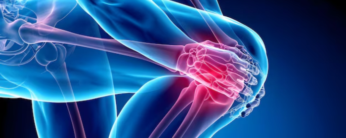 Cortisone vs Hyaluronic Acid: Which Would I Choose for Knee Pain