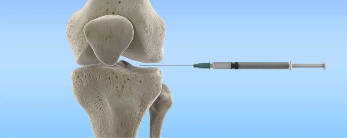 How Cortisone Injections Work for Joints